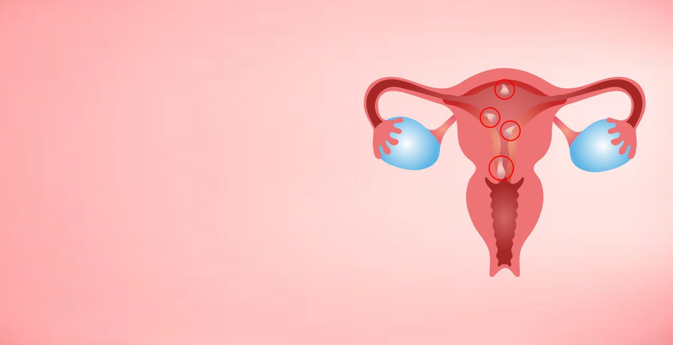 Endometrial Polyps (Uterine Polyps): Symptoms & Treatment | Indira IVF