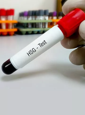 HSG Procedure: How is the HSG Test done Step by Step?