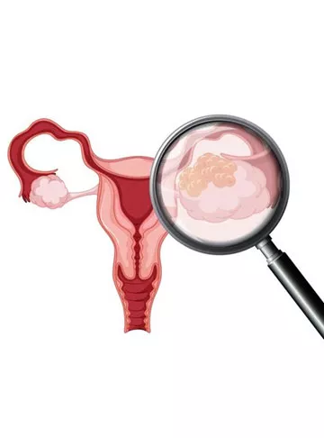 Fallopian Tube Cancer