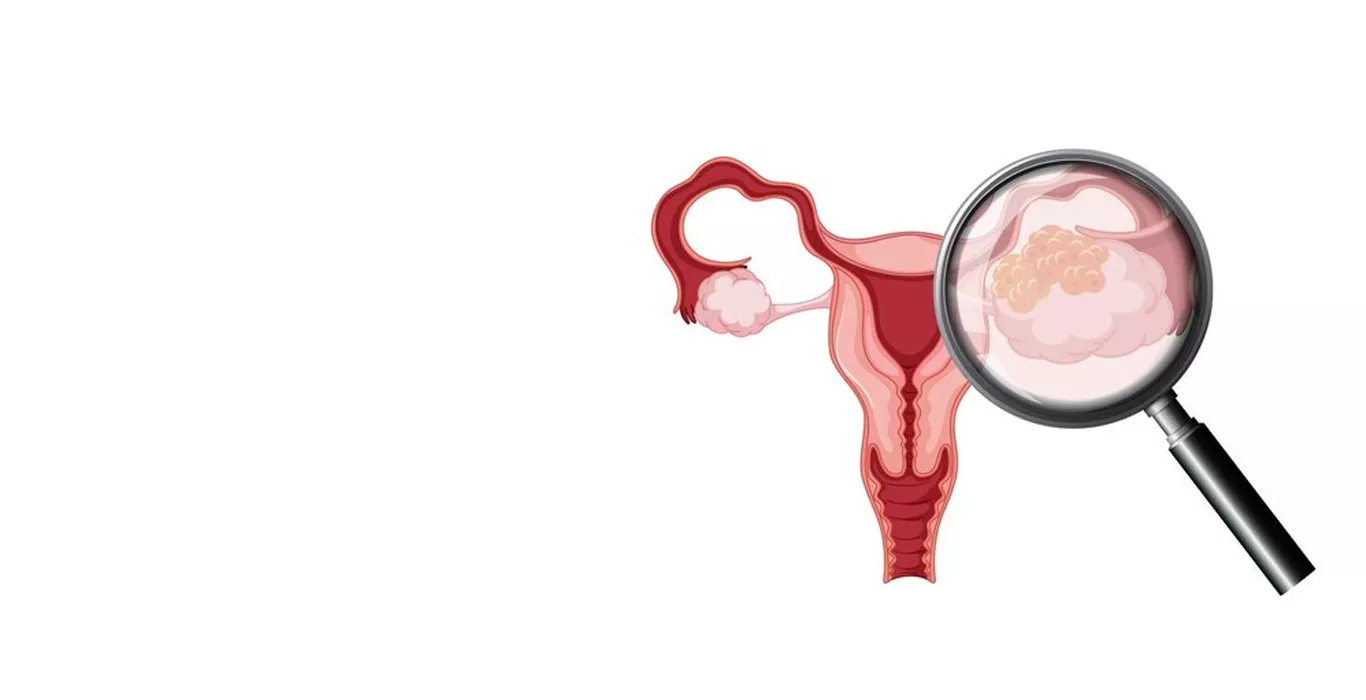 Fallopian Tube Cancer