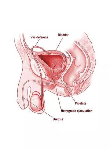 Retrograde Ejaculation