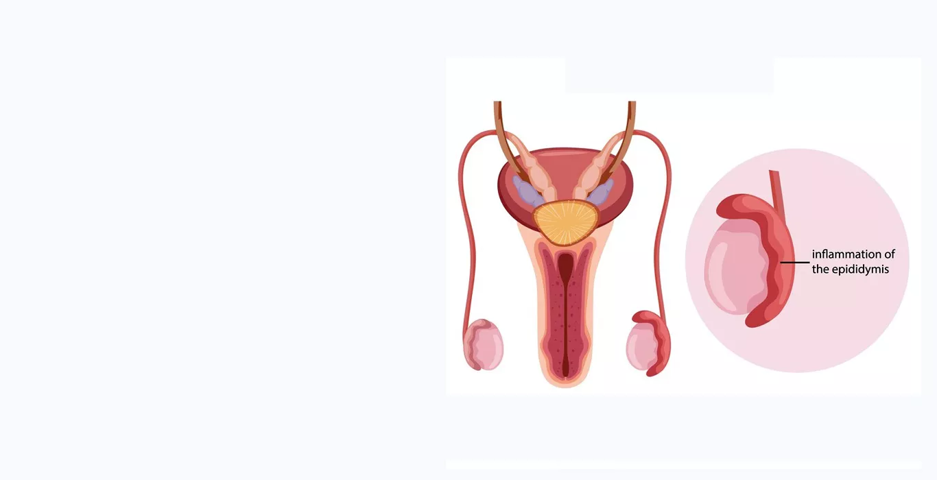 Epididymitis Types Causes Symptoms Treatment Indira IVF