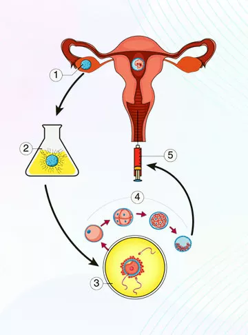 IVF and Embryo Transfer Process