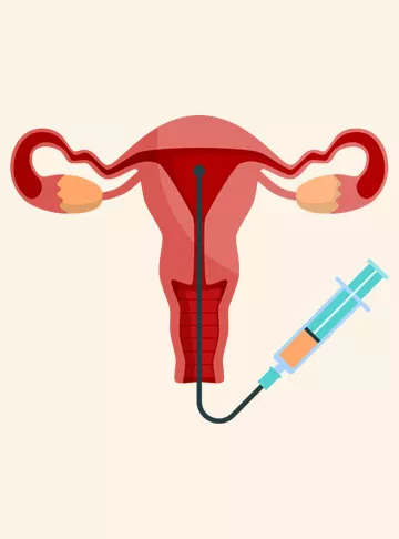 Is IUI painful?