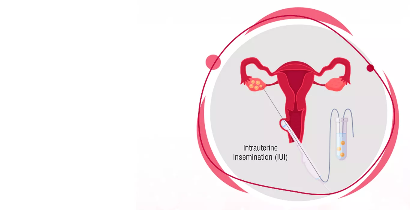 Intrauterine Insemination (IUI treatment)