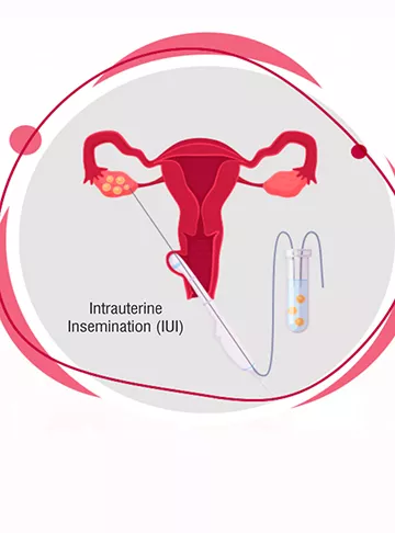 Intrauterine Insemination (IUI treatment)