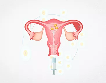 Treatments Offered Intrauterine Insemination (IUI)