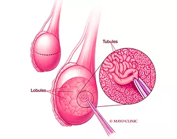 Treatments Offered Micro TESE